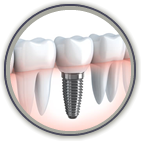 Dental Implants Clinton, NJ