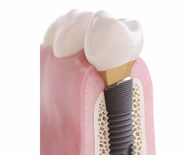 Choosing a Professional for Your Dental Implants in Clinton NJ