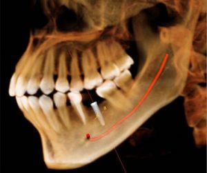 Dental implants Clinton NJ