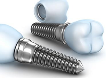 Implant dentist in Clinton NJ