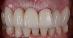 close up after dental bridge