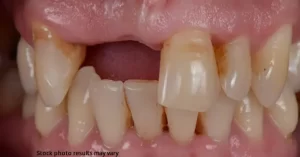 close up before dental bridge