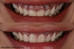 gum contoring before and after