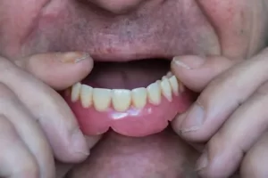 man putting dentures in mouth