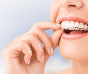 Keep Your Mouth Healthier by Choosing Invisalign Over Traditional Braces