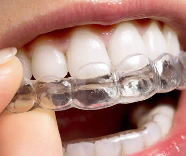 Getting a Stylish New Smile through Invisalign